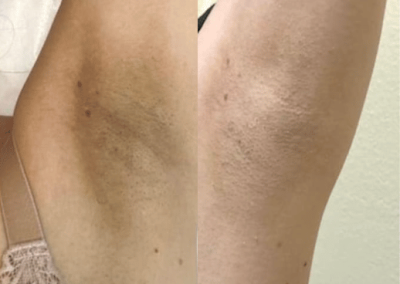 Armpit Bleaching Whitening, Lightening, and Brightening