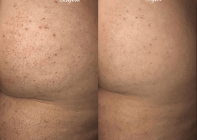 Rectal Bleaching Whitening, Lightening, and Brightening