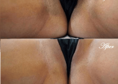 Vaginal Rejuvenation Bleaching Whitening, Lightening, and Brightening