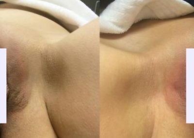 Close-up of two underarm areas side by side, with white censor bars covering central portions of each armpit.