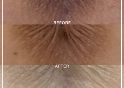 Three-panel close-up of skin showing texture progression: before (top), transition (middle), after (bottom) with the after image appearing smoother and lighter in tone.