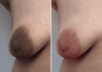 Before-and-after close-up of a nose tip: left panel shows dark brown hyperpigmentation, right panel shows lighter pink-toned skin after treatment.