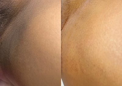 Close-up collage of underarm skin showing a dark-toned left side and a lighter right side with visible pores and fine hair.